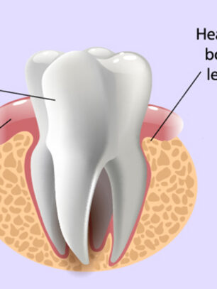 Easy Steps for a Successful Periodontal Treatment Recovery